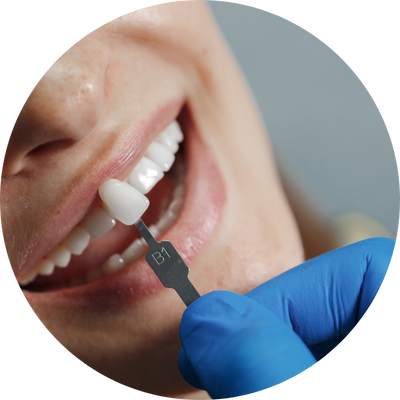 Facetas dentárias em Sorocaba para transformar o sorriso com estética natural e harmonia facial.