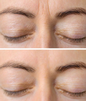 Antes e depois do tratamento com botox na testa, eliminando linhas de expressão na Harmodont Clínica Orofacial em Sorocaba.