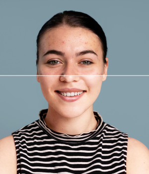 Antes e depois de harmonização facial completa na Harmodont Clínica Orofacial em Sorocaba, destacando simetria facial, melhora da pele e estética do sorriso.
