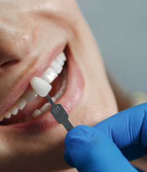 Corrija imperfeições no sorriso com facetas dentárias personalizadas na Harmodont, clínica em Sorocaba.
